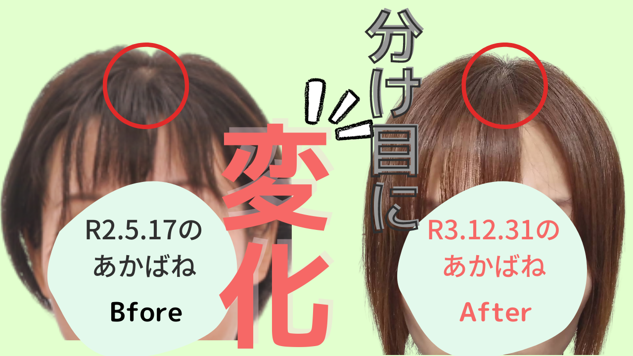 【薄毛に悩む30代女性に届けたい】気になる分け目に変化が！haruのシャンプーkurokamiスカルプを2ヶ月使った感想
